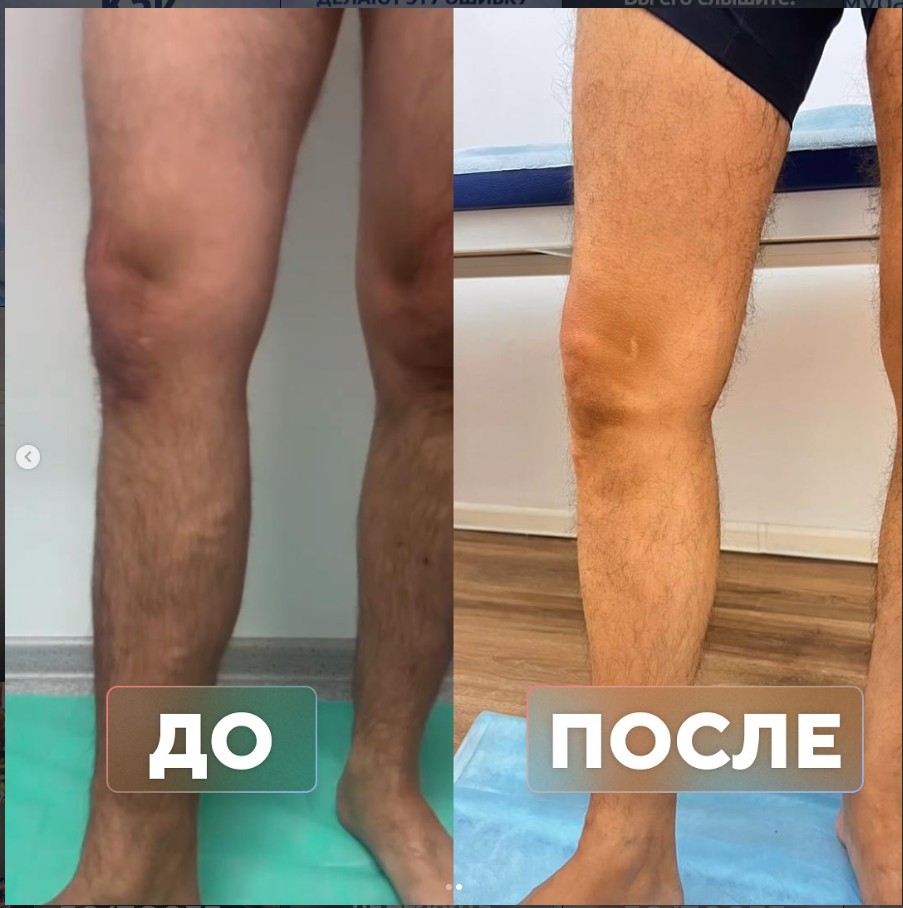 Варикоз у пилота с многолетним стажем — до и после лечения