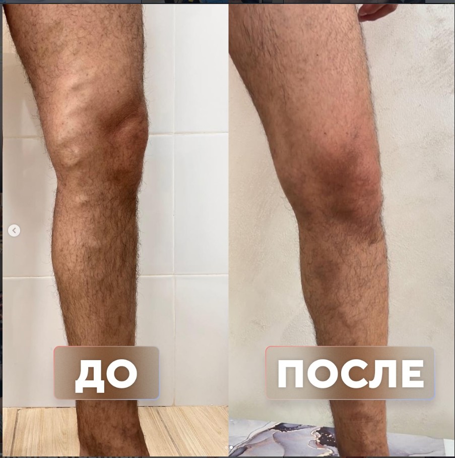 Молодой мужчина с варикозом около 6 лет — до и после лечения