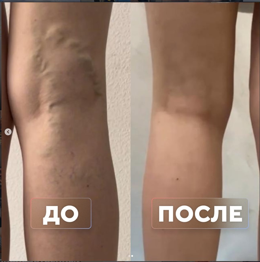 Варикоз после беременности — до и после лечения