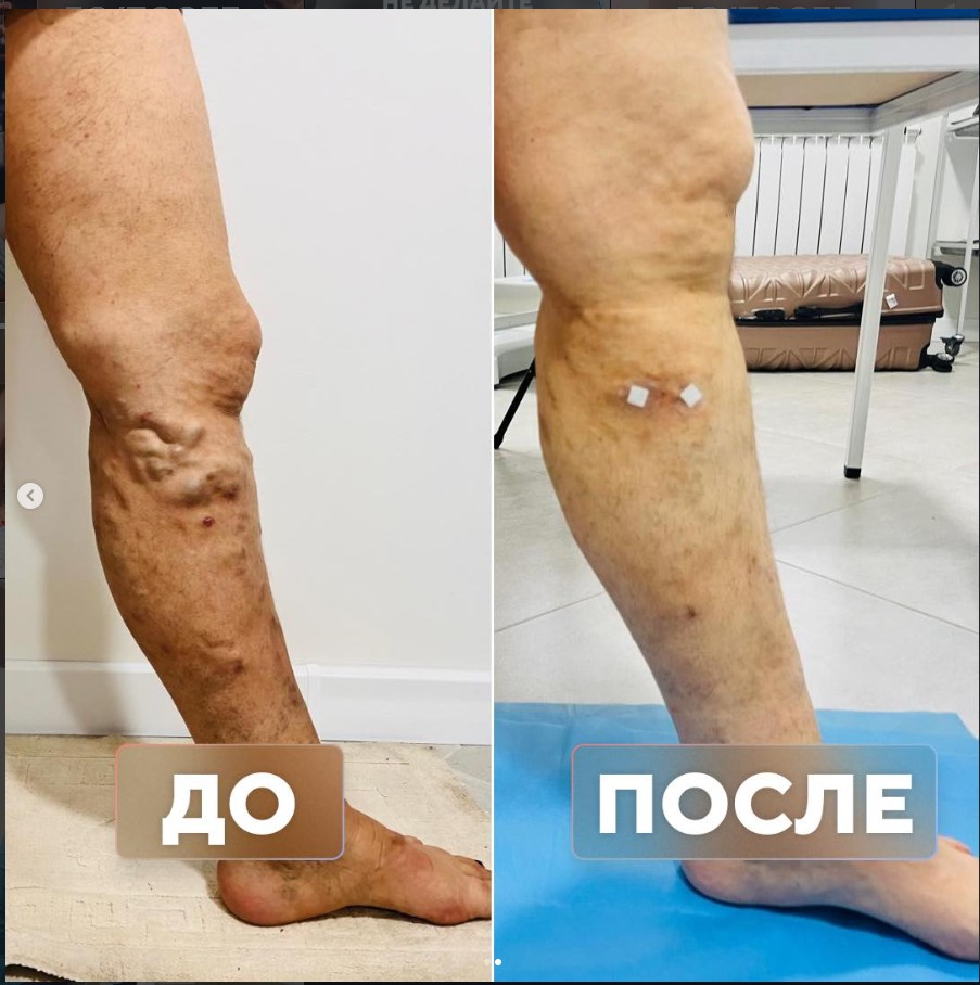 Наследственный варикоз и постоянная работа на ногах — до и после лечения