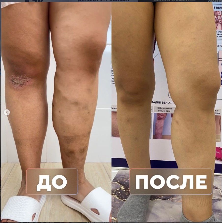 Осложнённый варикоз у пациентки 24 лет — до и после лечения