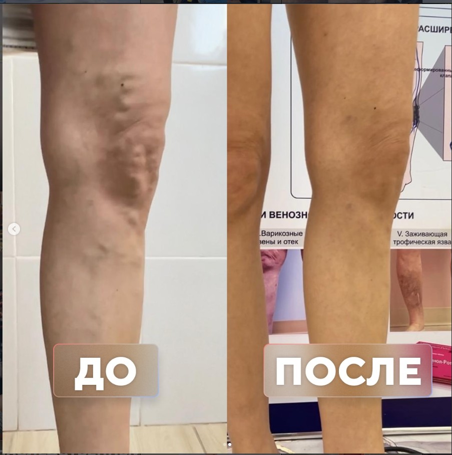 Варикоз более 20 лет — до и после лечения