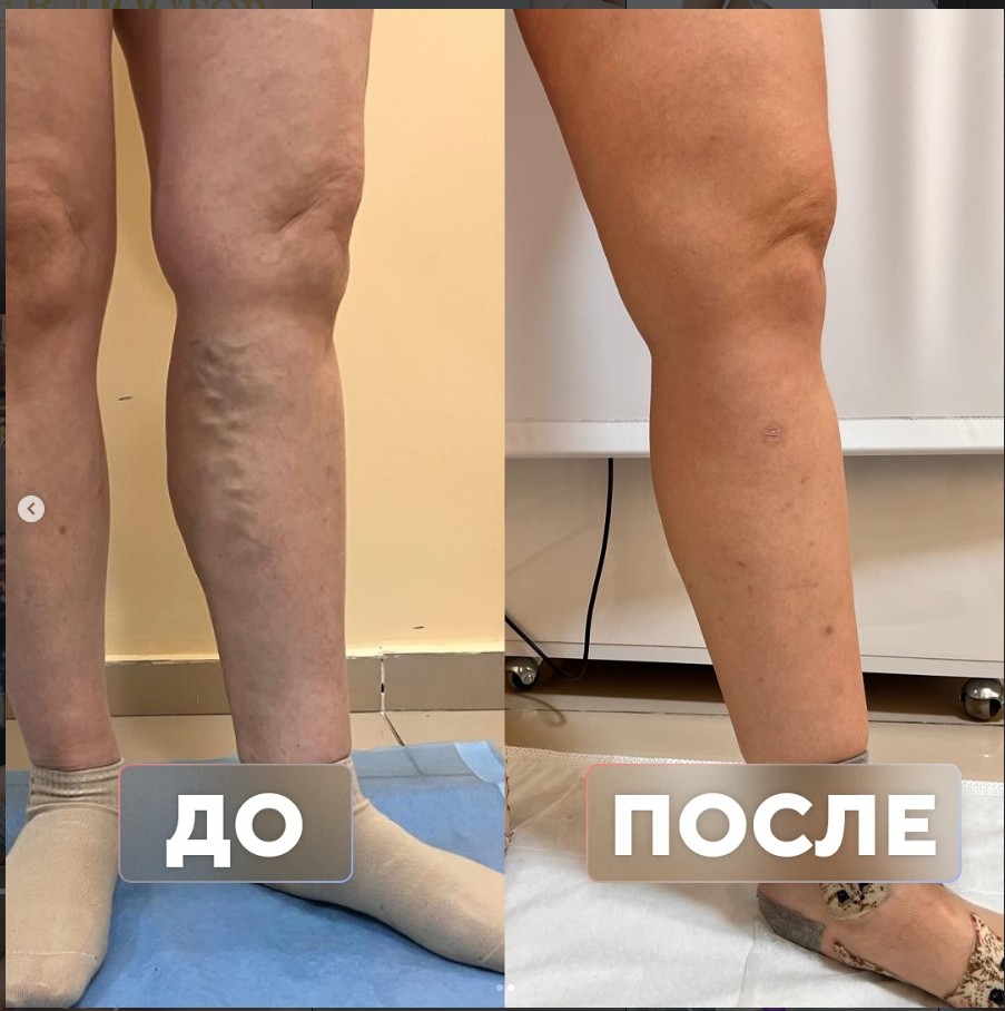 Варикоз более 15 лет при работе парикмахером — до и после лечения