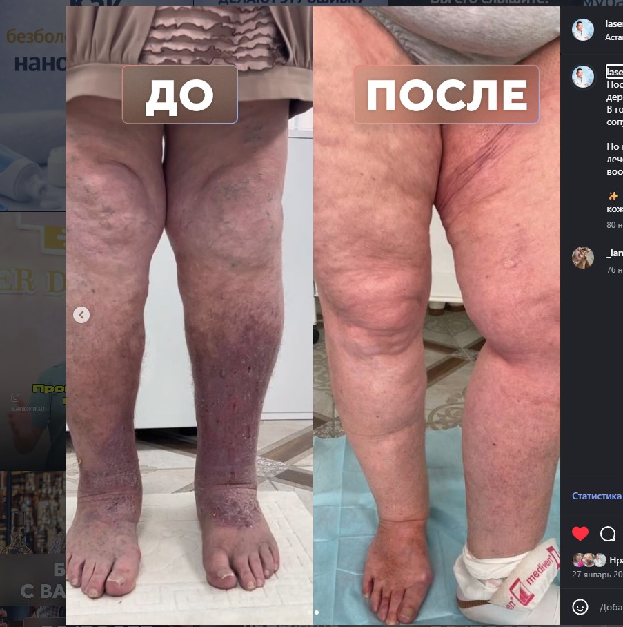 Длительный варикоз с выраженными изменениями кожи — до и после лечения